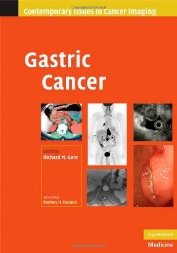 Gastric-Cancer