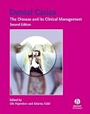 Dental Caries: The Disease and Its Clinical Management