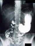 X-Ray Peptic Ulcer of the Stomach Photographic Poster Print, 30x40