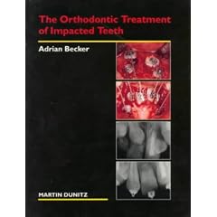 The Orthodontic Treatment of Impacted Teeth