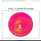 EXTRA-CAPSULAR EXTRACTION