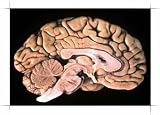 Tapping the Full Potential of Novel Antipsychotics: A Video Symposium (Self Study Includes Syllabus) CME