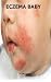 Eczema Baby 41ACAaeKZXL. SL75 Eczema Treatment Plus Good Care Equals Lot of Happiness