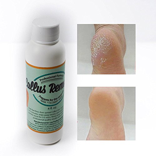 Best Callus Remover.Callus Eliminator,Liquid & Gel For Corn And Callus