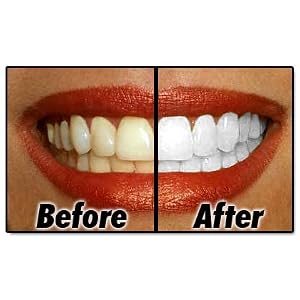 AT HOME TEETH WHITENING - Turns stained teeth white again