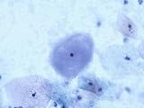 Gardnerella Vaginalis Clue Cells Pap Smear X10 Photographic Poster Print, 24x18