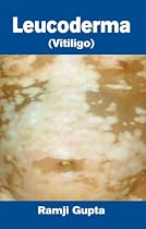 Leucoderma: Vitiligo