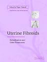 Uterine Fibroids: Embolization and other Treatments
