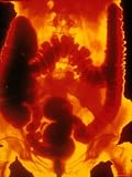 Enhanced X-Ray Abdomen Female X-Ray GI-Tract Photographic Poster Print, 18x24