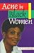   - Acne in Black Women