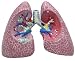 Diseased Lung Model. This is the Model 311 and comes with a Money Back Guarantee and a 1-Year Factory Warranty.