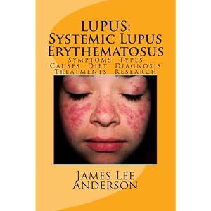 LUPUS:  Systemic Lupus Erythematosus: Symptoms. Types. Causes. Diet.  Diagnosis. Treatments. Research.