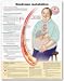 Metabolic Syndrome Anatomical Chart Paper Unmounted- IN SPANISH ISBN: 978-0-7817-7308-9 In Spanish language paper chart