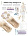 Understanding Osteoporosis