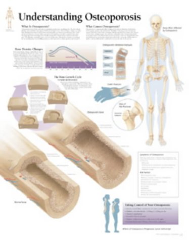 Understanding Osteoporosis
