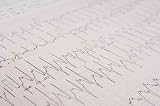 Ecg - 36