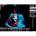 Doppler Transesoph. Echo. Ultrasound A.Septal Defect Photographic Poster Print, 40x30
