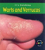 Warts and Verrucas (Its Catching)