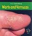 It's Catching: Warts and Verrucas