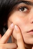 Understanding Acne to Cure it the Easy Way