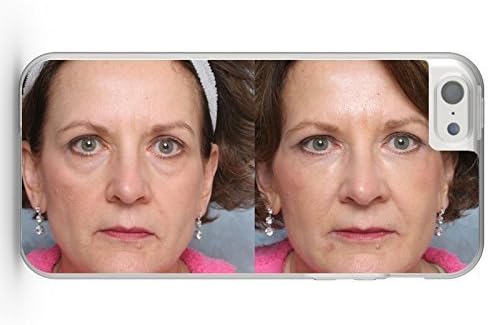 iPhone 5C cover case ForeheodLitt Filler Case Studies Deepfill Restylane Microdroplet Botox