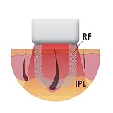 HoMedics Me My Elos Quartz - Depiladora, tecnología ELOS, potencia total de 9 joules/cm2