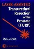 Laser-Assisted Transurethral Resection of the Prostate (Turp)