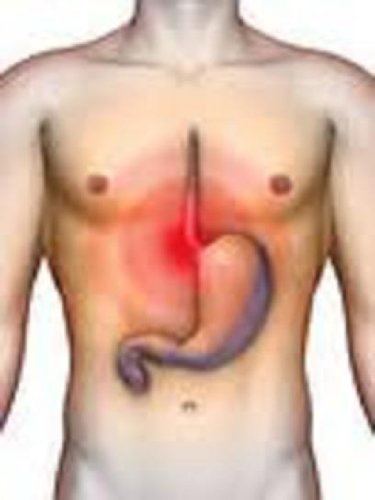 Treatment Of Acid Reflux