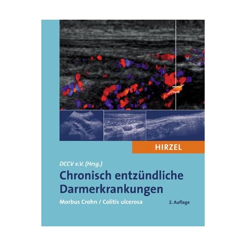 Chronisch entzündliche Darmerkrankungen
