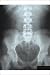 Photographic Print of X Ray Lumbarsacral Spine And Pelvis from Cmsp