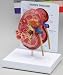 Anatomical Human Diseased Kidney Cancer Model