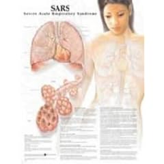 SARS: Severe Acute Respiratory Syndrome Anatomical Chart