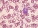 Hypochromic Microcytic Anemia Hemoglobin Iron Photographic Poster Print, 16x12