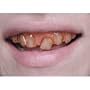 Hillbilly Grillz Teeth Adult