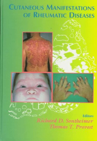 Connective-Tissue-Disorders