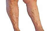Natural Ways To Let Varicose Veins Dissapear. How To Treat Varicose Veins, Or Better Still: Prevent Them