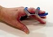 `Toad Finger Splint Large `Toad Finger Splint Large