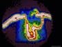 Nuclear Medicine-Gamma Camera Scan Showing Occlusion of Venacava, Heart in Lower Center Photographic Poster Print by David M. Dennis, 24x18