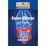 Colon Cancer (Diseases and Disorders) by Toney Allman
