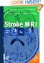 Stroke Mri