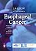 Esophageal Cancer