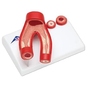 3B Scientific G40 2 Part Arteriosclerosis Model with Cross Section of Artery