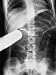X-Ray Showing Tube Moving Through Patient's Stomach as Magnet Guides It Photographic ...