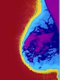 Pseudocolored X-Ray Female Breast Showing Density Photographic Poster Print, 18x24