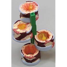 Click here to buy Bronchus Model 4-pc Set Asthma Bronchitis by Lake Forest Anatomicals Organ Models.
