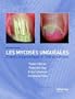 Onychomycosis/Les mycoses ungueales: Etapes diagnostique et clinique