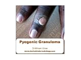 Pyogenic Granuloma (Dermatology)