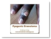 Pyogenic Granuloma (Dermatology)