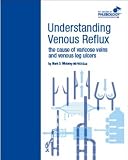 Understanding Venous Reflux the Cause of Varicose Veins and Venous Leg Ulcers