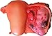 Herindera Ovarian Cancer RS.1500.00
